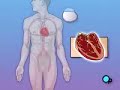 PreOp® Patient Education Permanent Pacemaker Implant Surgery