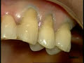 Class V restoration Dr. P. Colon - Dyract eXtra /1
