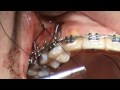 Upper anterior (intrusion) skeletal anchor placement, part 2, closure
