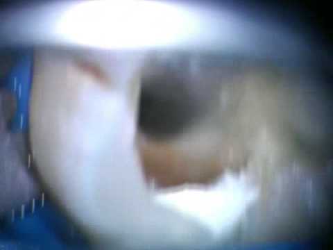 Erbium Laser Disinfection of Root ...