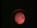 Retina Surgery. Peeling ILM in Macula hole case