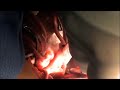 VSD Repair, Perimembranous Ventricular Septal Defect