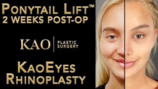 Ponytail Lift™ KaoEyes and Rhinoplasty = The Trifecta of Facial Beautification - Kao Plastic Surgery