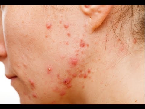 how to relieve acne pain