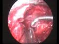 videos de Endoscopic Posterior Cervical Discectomy