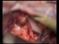 Acoustic neuroma - Retrosigmoid approach