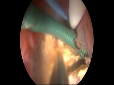 how to remove dj stent