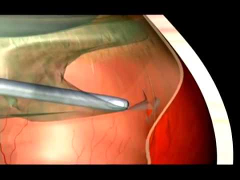 Видео Отслойка сетчатки и её лечение