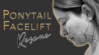 Botched Facelift Left Her With Horrible Scars! - Ponytail Facelift™ Rescue!