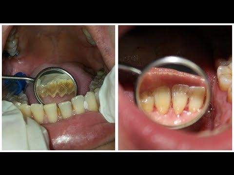 how to get rid plaque on teeth