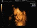My Daughter at 27 Weeks Gestation My Daughter at 27 Weeks Gestation
