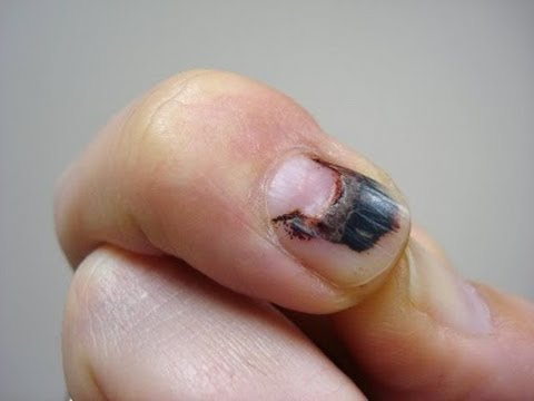 how to relieve fingernail pain