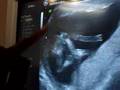 Ultrasound of Baby Malak (15 weeks)