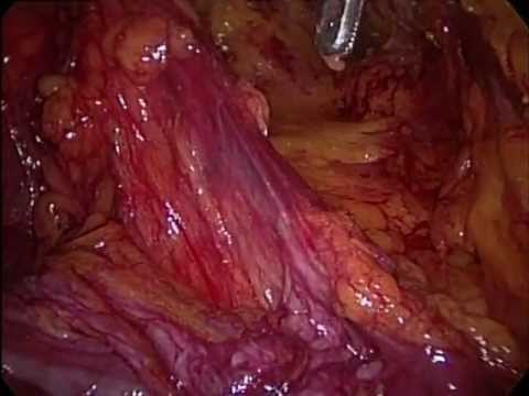 hernioplastia - Hernioplastia laparoscópica Total Extra Peritoneal TEP en hernia inguinal izquierda indirecta. Dr. Juan Carlos Mayagoitia González.
