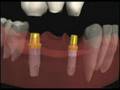 Implantes-Dentales