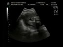 Ultrasound Rakelly 29 semanas Parte 2