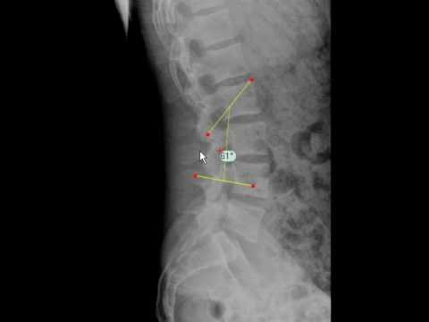 how to measure cobb angle kyphosis