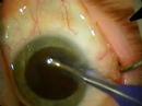 Dr Holmes Cataract Surgery -- www.ProcedureMD.com-- surgical