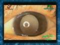 Dr.Tuwairqi Lasik Documentary (3/4)