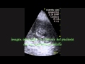 Left Ventricular Aneurysm Left Ventricular Aneurysm