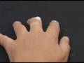 home wart removal  - easy wart Remover - Mole & Wart EZ Clear