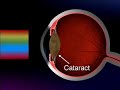 Cataract - what is it: Vantagevideo