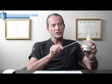 Dr. Tony Mork Discusses Annular Tears of the Intervertebral Disc