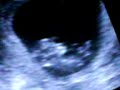 baby Shirey 10 weeks baby Shirey 10 weeks