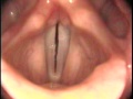 Vocal cords can be seen vibrating at high and low pitches for comparison of their length. The cricothryoid muscle contracts and lengthens the vocal cords at the higher pitch. Rigid endoscope