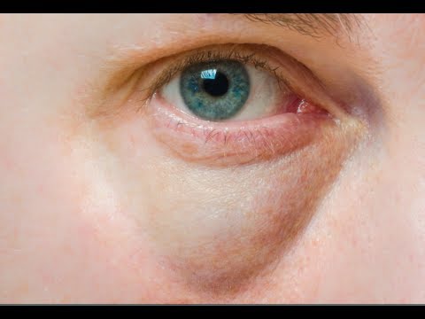 how to relieve eye puffiness