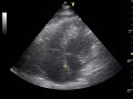 ANEURISMA SEPTO INTERATRIAL