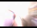 MiXto SX Micro Fractional Laser