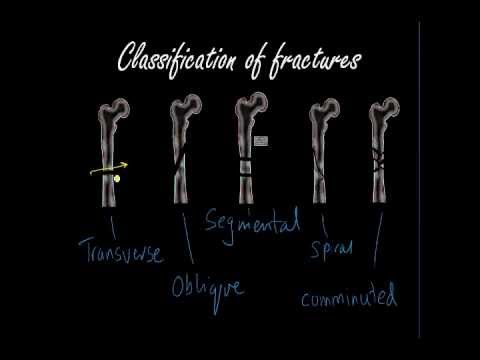 how to know fracture in x-ray