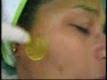peeling