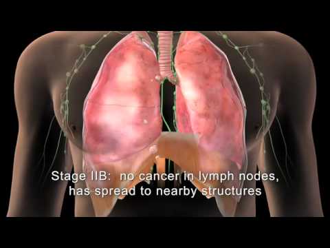 how to discover lung cancer early