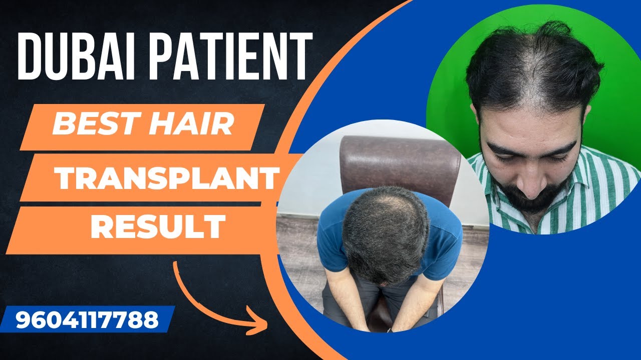 Dubai Patient's Hair Transplant in Pune|| Best Hair Transplant Clinic in Pune