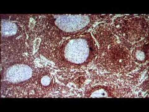Journey's Through Lymphoma: Mark's ...