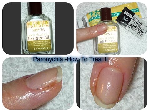 how to cure paronychia