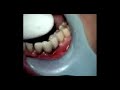Partial Lower Anterior