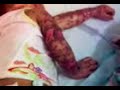 steven johson syndrome steven johson syndrome