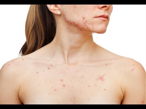 how to get rid of acne on body