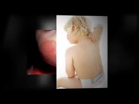 how to help baby eczema