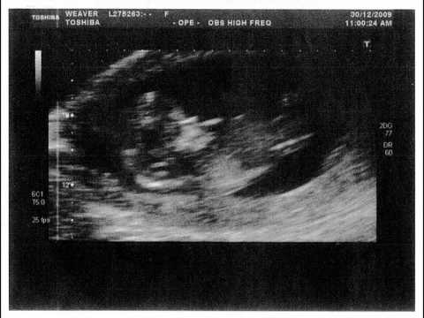 Our Baby 12 week ultrasound scan and heartbeat