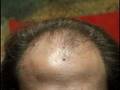 Creating and placing hair transplant grafts