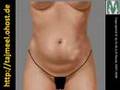 Body Contouring (ARABIC)  د. محمد الروبى جراحات تجميل القوام