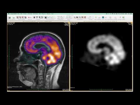 FusionSync Tutorial – Part 02: MR-SPECT Epilepsy