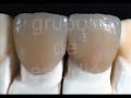 Revista Alta T�cnica Dental - Una Visi�n