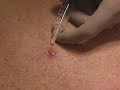 Injection of Local Anesthetic