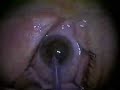 my-lasik-eye-surgery.html