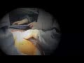 C-Section